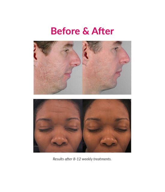 Zdjęcie produktu 4 z 6, PMD Personal Microderm Pro Mikrodermabrazja